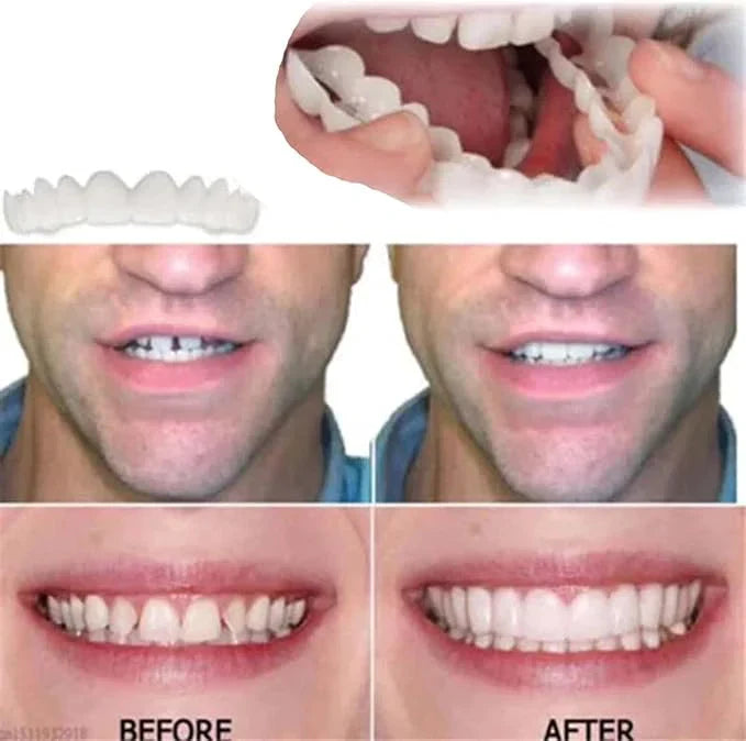 Adjustable Snap-On Dentures