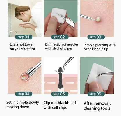 Acne Blackhead Removal Tool Kit